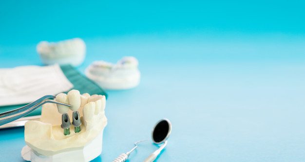 implan-model-tooth-support-fix-bridge-implan-crown