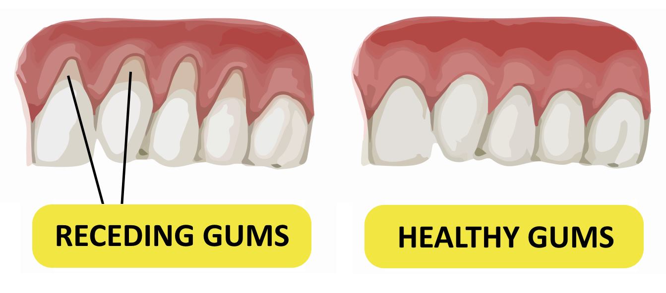 Everything you need to know about receding gums - Signature Smile