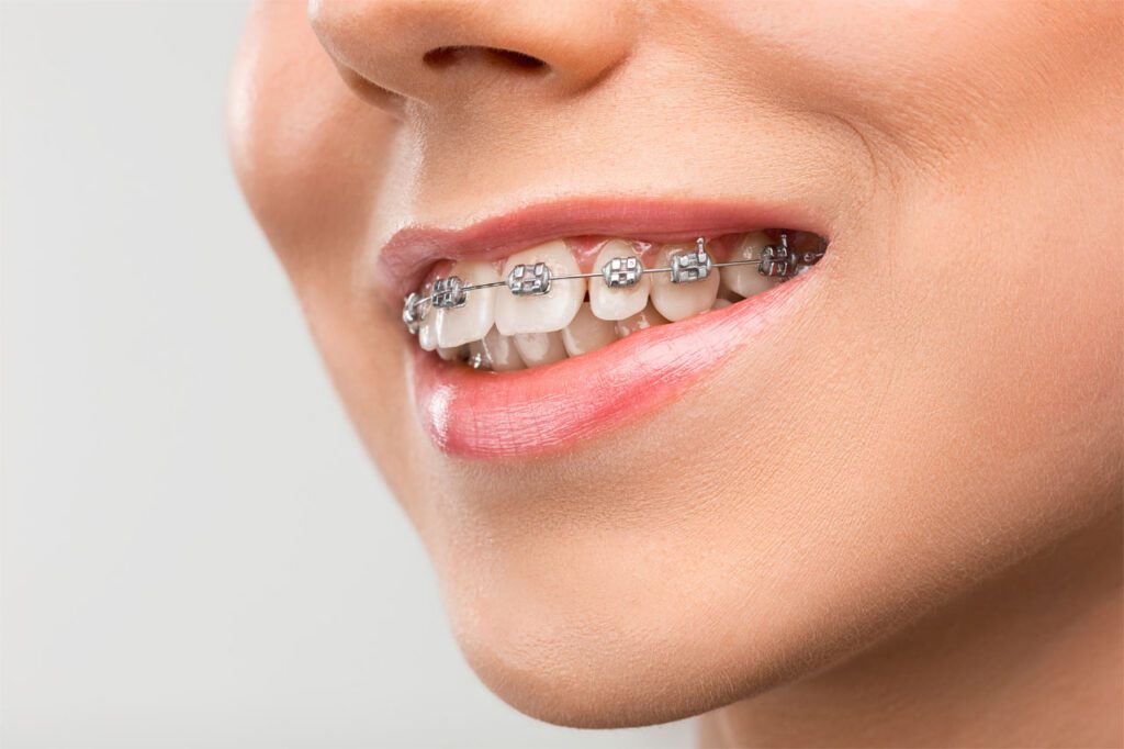 braces on woman teeth