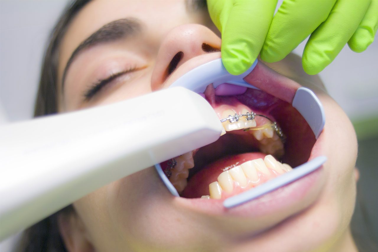 dentist scanning patient teeth with iTero scanner