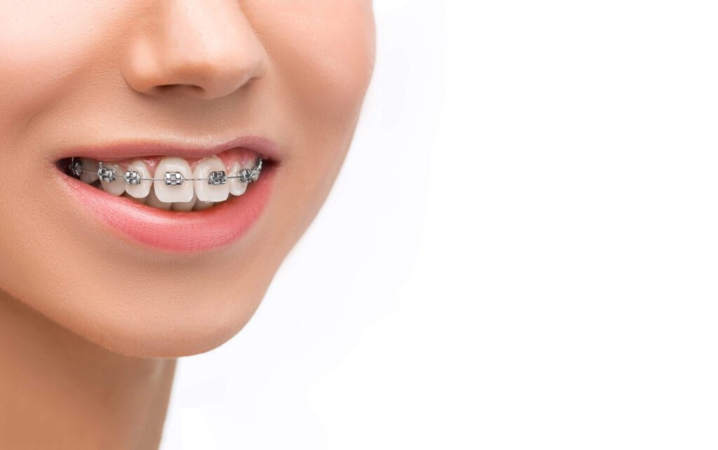 Beautiful young woman with teeth braces on gray
